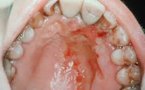 http://www.uv.es/medicina-oral/Docencia/atlas/hematologicasFOTOS/herpes.jpg