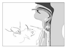      tracheostomy  tube inner   cannula 