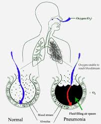 ' Pneumonia 