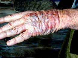 spill of chemotherapy onto - via Daymix