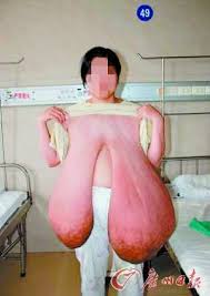 泌乳素失调女子被43斤巨乳所累