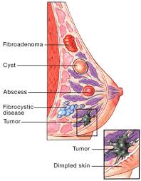 http://www.aidforwomen.com/breast1.jpg