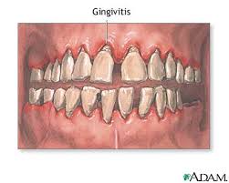  Gingivitis 
