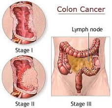 Colon Cancer | TopNews Health