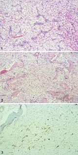 http://atlasgeneticsoncology.org/Tumors/Images/Adamantinoma.jpg
