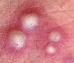 White  pustule  forms ~ 24 hours