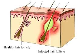 Treating Blackhead Pores