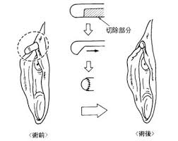 場合には、クリトリス切除法