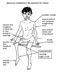 Infantile Paralysis - via Daymix