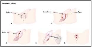  gender reassignment surgery 