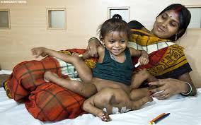 toddler with eight limbs
