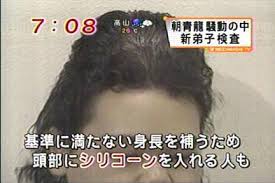 頭部にシリコンを入れ低身長を