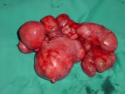  abdominal -pelvic  mass  (17