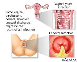   Vaginal   discharge