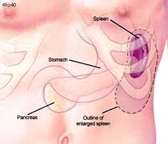 Clinics, Splenomegaly 