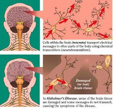 DBS :: Deep Brain Stimulation - Alzheimer's Disease