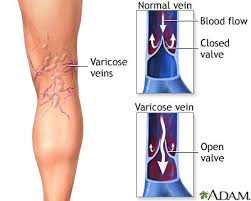  Varicose veins 