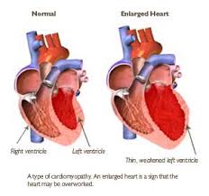About  heart failure 