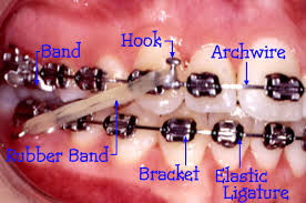 Restoration 101 » braces