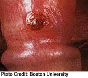 Syphilis and Neurosyphilis