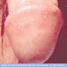 OhioHealth -  Genital herpes 