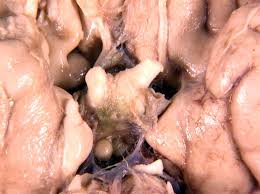 The optic  chiasm   was enlarged to 1 5    