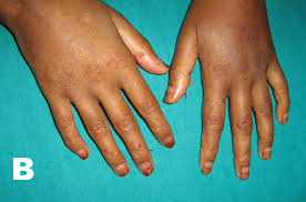 http://dermatology.cdlib.org/133/case_presentations/acrodermatitis/1b.jpg