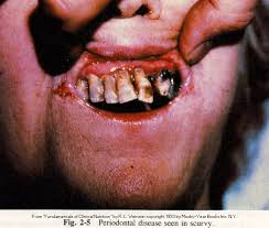  bleeding into  the  skin )