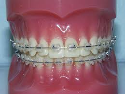 I got braces!