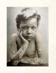 Leprosy, Hansen's Disease - via Daymix