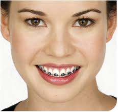 Orthodontics and Braces: Get