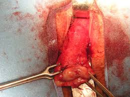   Vaginal   Hysterectomy Photos