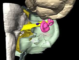 Tiny  Acoustic Neuroma : This
