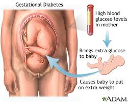 Gestational Diabetes