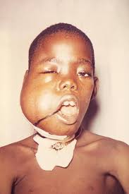with a large facial tumor