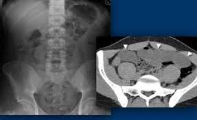 LEFT: Plain  abdominal film  in