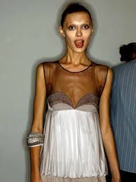 anorexic-model