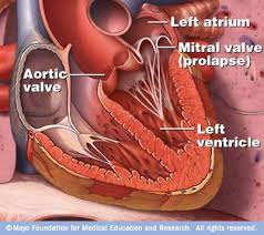  Mitral Valve Prolapse  Diagram