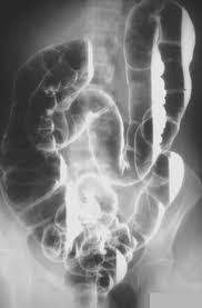 Air Contrast Enema - Colon
