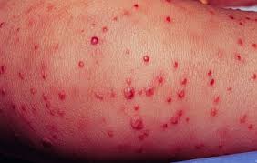http://www.topnews.in/files/staph-infection.jpg