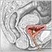  Bilateral Obstructive 
