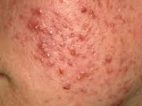 http://www.apply-makeup.info/skin-disease/acne-vulgaris-picture.jpg