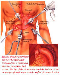  Anti-Reflux Surgery  for