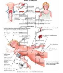  Toxic Shock Syndrome 