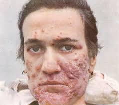 http://luskiewnik.strefa.pl/akne/user/image/acne_vulgaris400.jpg