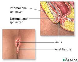 Anal fissures are tears in the skin