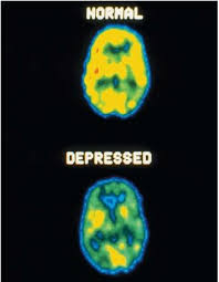 has  major depression ,