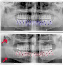 Dental XRays of my  Acromegaly 