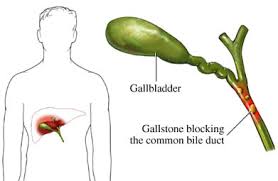 http://www.thelivercarefoundation.org/cache/Cholangitis1.jpg