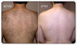 Hair Removal